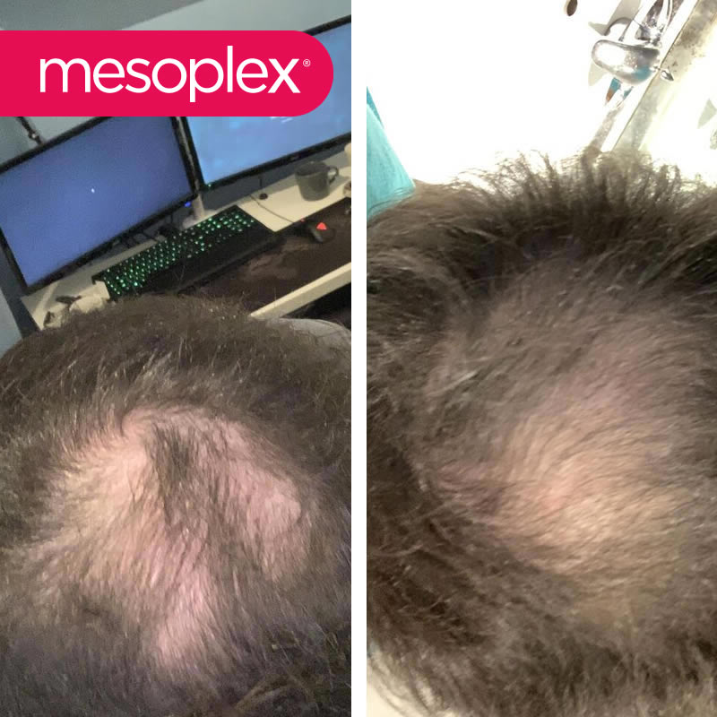 Mesoplex Resmi Satış Sitesi