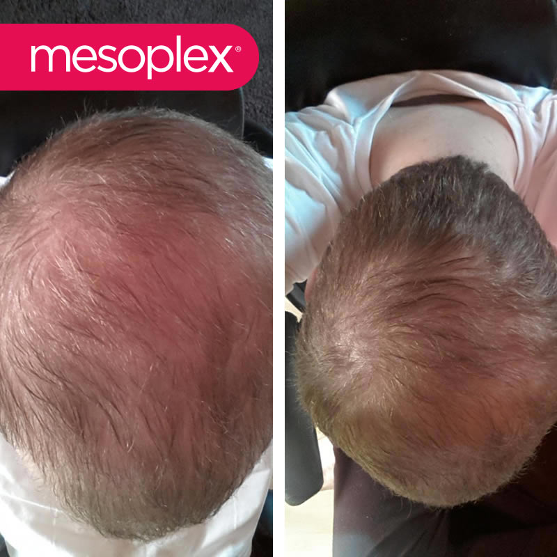 Mesoplex Resmi Satış Sitesi