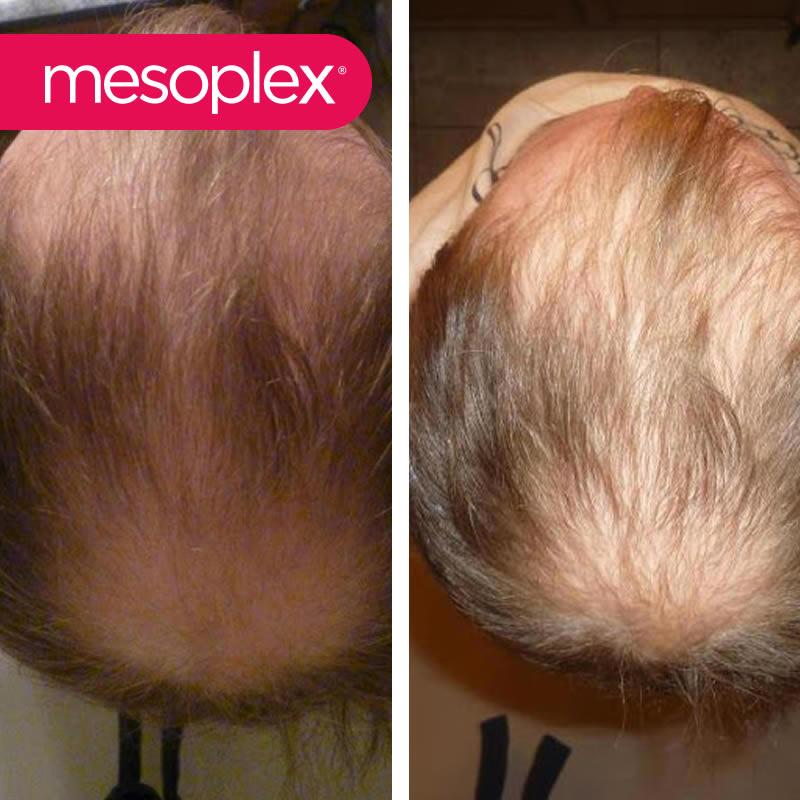 Mesoplex Resmi Satış Sitesi