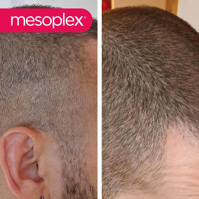 Mesoplex Resmi Satış Sitesi