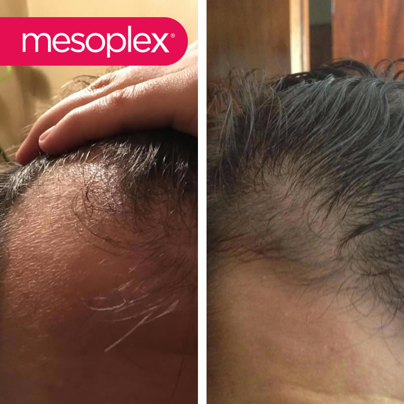 Mesoplex Resmi Satış Sitesi