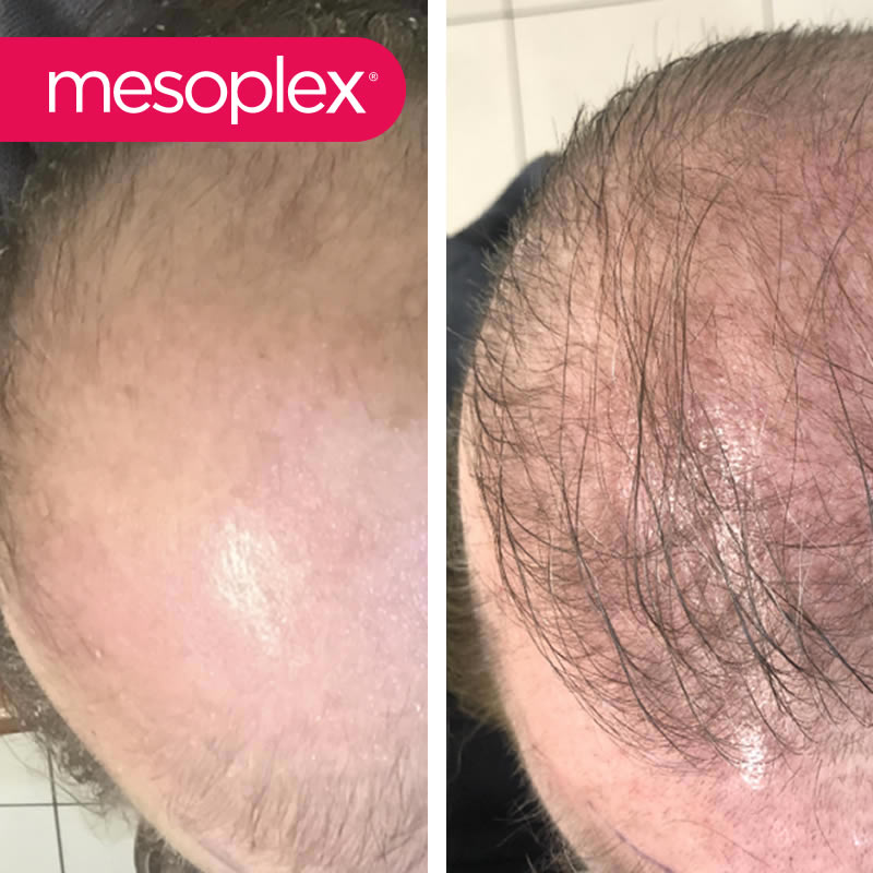 Mesoplex Resmi Satış Sitesi